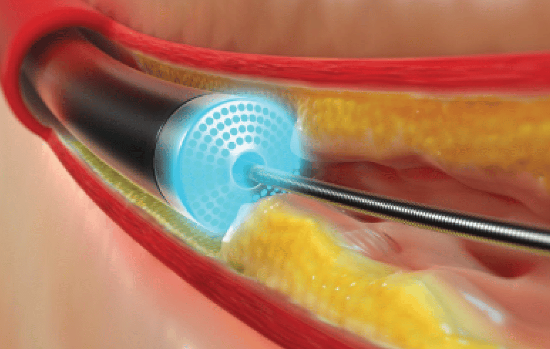 Laser Angioplasty in Tamil Nadu, Tirunelveli Laser Angioplasty in Tamil Nadu, Tirunelveli